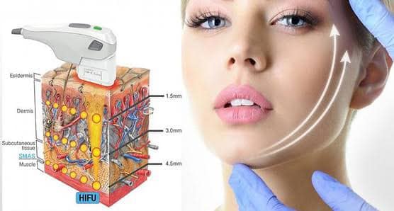 HIFU FACIAL PACKAGE $999